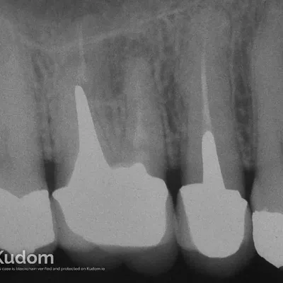 Apical Microsurgery of Upper Molar Mesiobuccal Root - Image 1