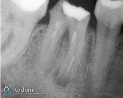 Perforazione Iatrogena Molare Inferiore - Immagine 1