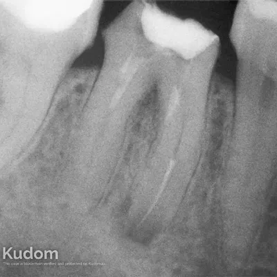 Lower Molar Iatrogenic Perforation - Image 1