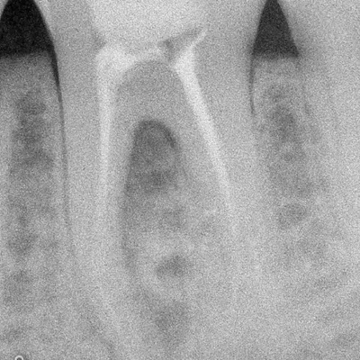 Complex Lower Molar Retreatment - Image 1