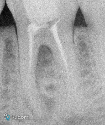 Ritrattamento Complesso Molare Inferiore - Immagine 1
