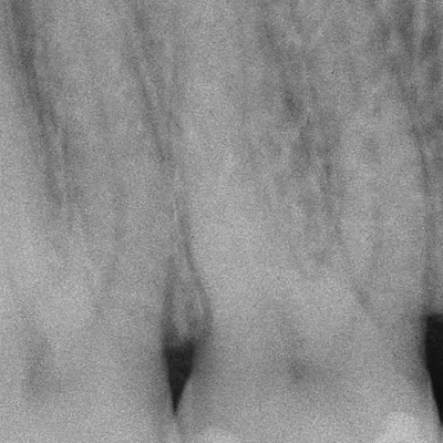 Upper Molar Root Canal Treatment - Image 1