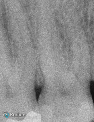 Terapia Canalare Molare Superiore - Immagine 1