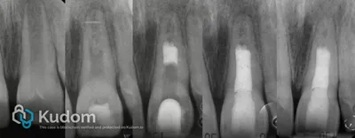 Rigenerazione Pulpare Centrale Superiore - Immagine 1