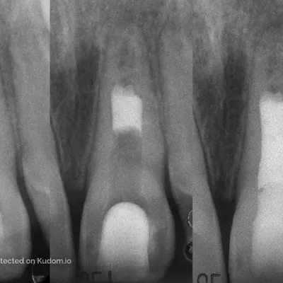 Upper Central Incisor Pulp Regeneration - Image 1