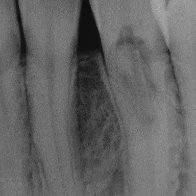 Lower Canine External Resorption - Image 1