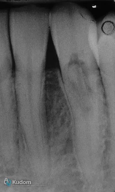 Riassorbimento Esterno Canino Inferiore - Immagine 1