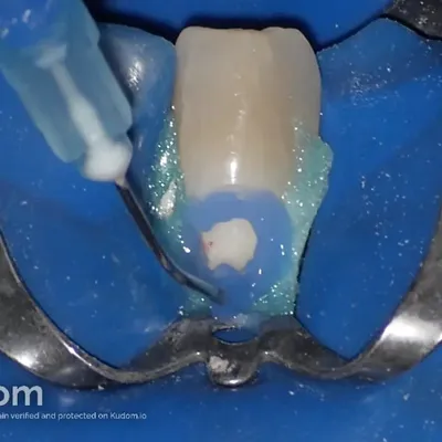 Lower Canine External Resorption - Image 10