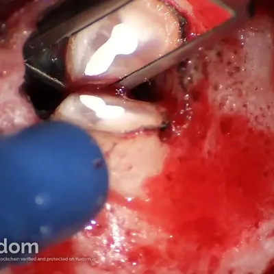 Apical Microsurgery of Upper Molar Mesiobuccal Root - Image 10