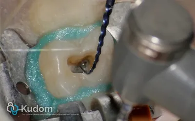 Terapia Canalare Molare Superiore - Immagine 10