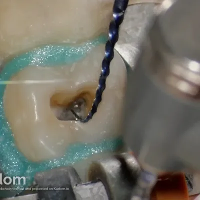 Upper Molar Root Canal Treatment - Image 10