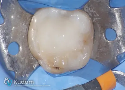 Ritrattamento Complesso Molare Inferiore - Immagine 10