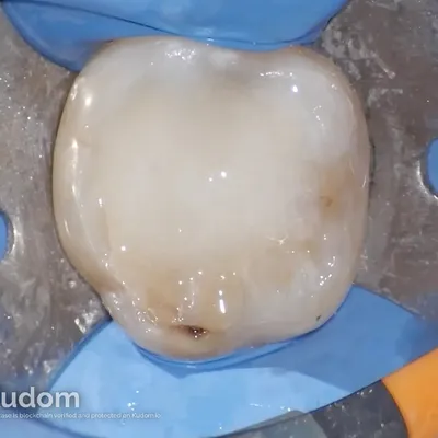 Complex Lower Molar Retreatment - Image 10
