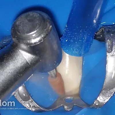 Lower Canine External Resorption - Image 11