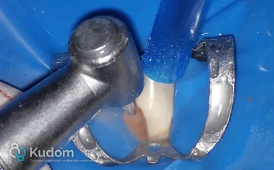 Riassorbimento Esterno Canino Inferiore - Immagine 11