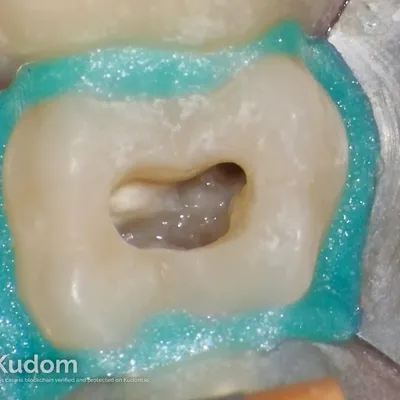 Upper Molar Root Canal Treatment - Image 11