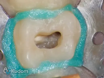 Terapia Canalare Molare Superiore - Immagine 11