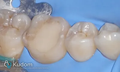 Ritrattamento Complesso Molare Inferiore - Immagine 11