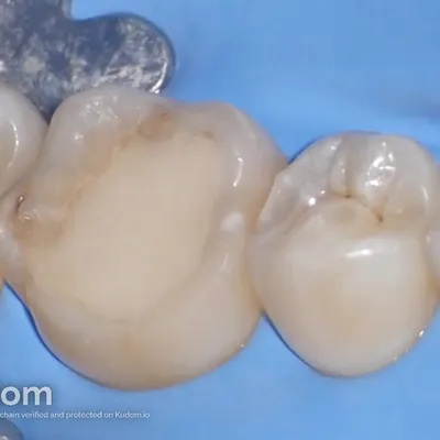 Complex Lower Molar Retreatment - Image 11