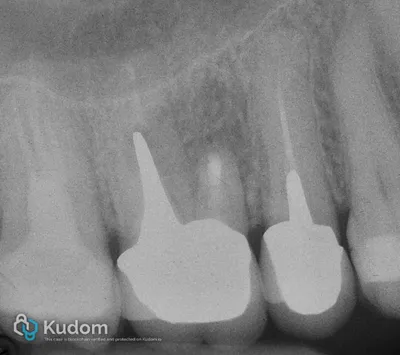 Microchirurgia Apicale Radice Mesio-Vestibolare di Molare Superiore - Immagine 11