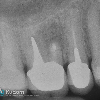 Apical Microsurgery of Upper Molar Mesiobuccal Root - Image 11