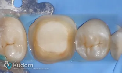 Ritrattamento Complesso Molare Inferiore - Immagine 12