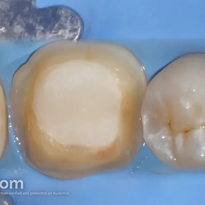 Complex Lower Molar Retreatment - Image 12