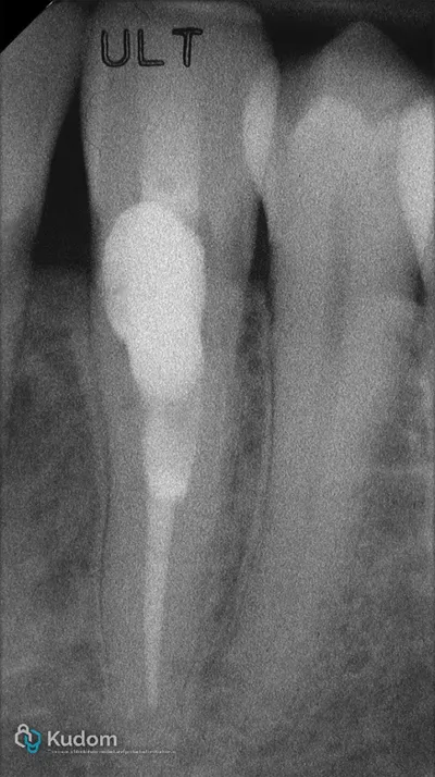 Riassorbimento Esterno Canino Inferiore - Immagine 12