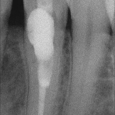 Lower Canine External Resorption - Image 12