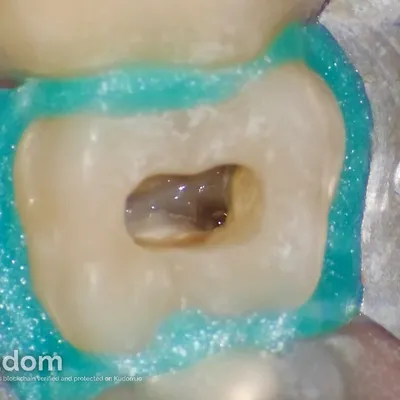 Upper Molar Root Canal Treatment - Image 12