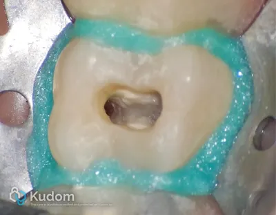 Terapia Canalare Molare Superiore - Immagine 13