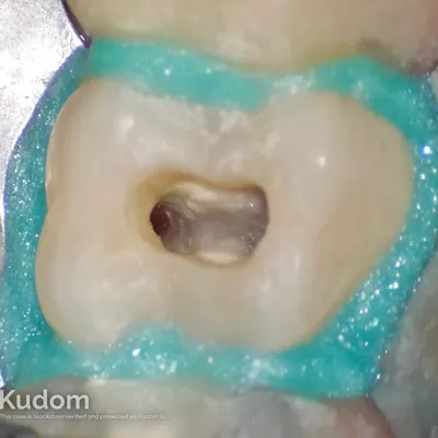 Upper Molar Root Canal Treatment - Image 13