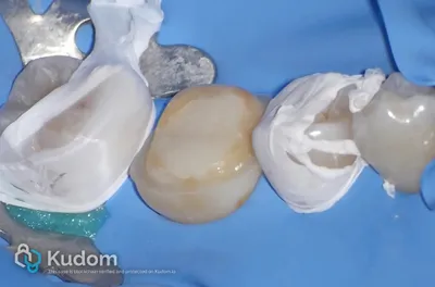 Ritrattamento Complesso Molare Inferiore - Immagine 13