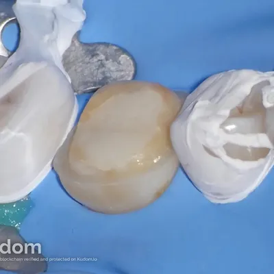 Complex Lower Molar Retreatment - Image 13