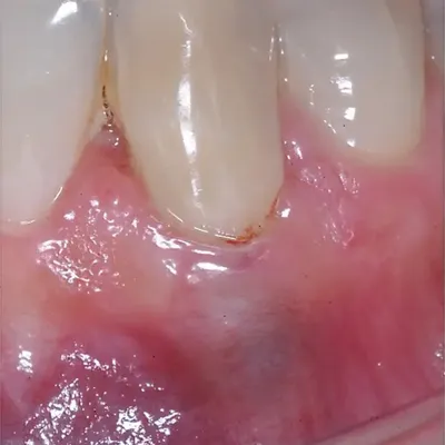 Lower Canine External Resorption - Image 13