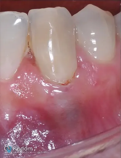 Riassorbimento Esterno Canino Inferiore - Immagine 13