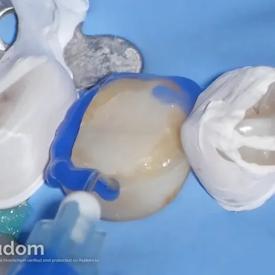 Complex Lower Molar Retreatment - Image 14