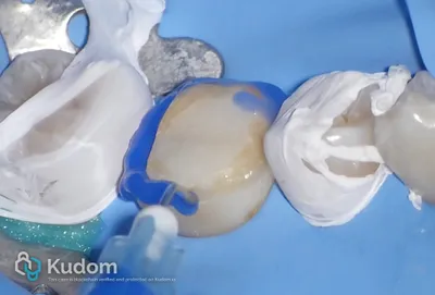 Ritrattamento Complesso Molare Inferiore - Immagine 14