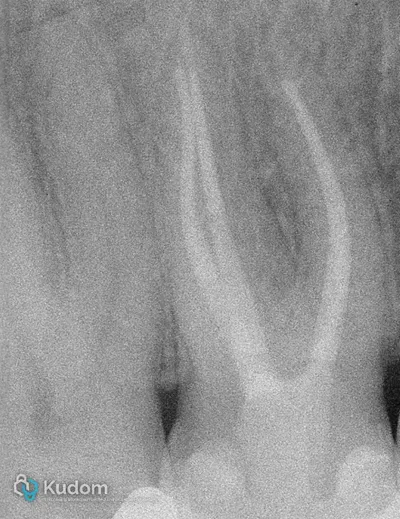 Terapia Canalare Molare Superiore - Immagine 14