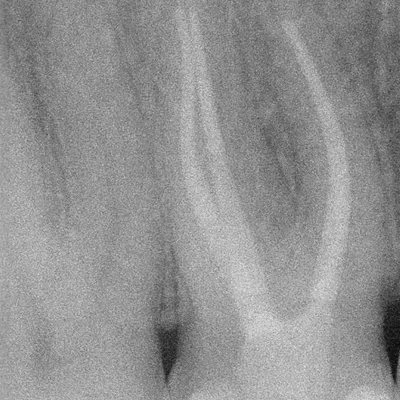 Upper Molar Root Canal Treatment - Image 14
