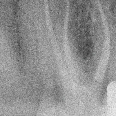 Upper Molar Root Canal Treatment - Image 15