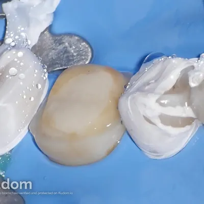 Complex Lower Molar Retreatment - Image 15