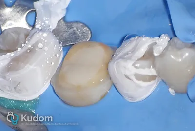 Ritrattamento Complesso Molare Inferiore - Immagine 15