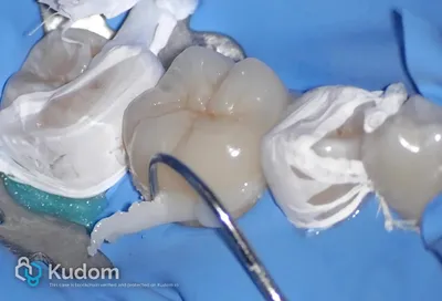 Ritrattamento Complesso Molare Inferiore - Immagine 16