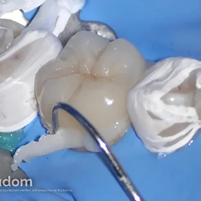 Complex Lower Molar Retreatment - Image 16