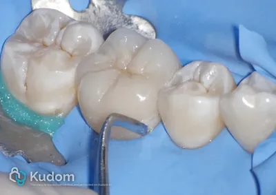 Ritrattamento Complesso Molare Inferiore - Immagine 17