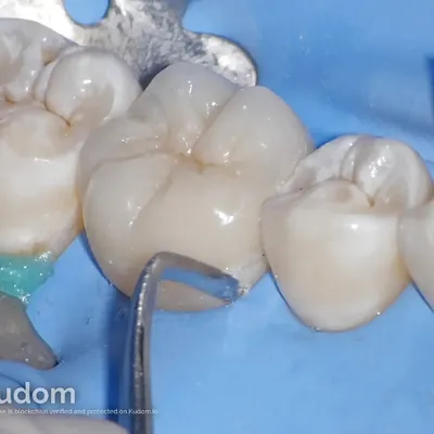 Complex Lower Molar Retreatment - Image 17