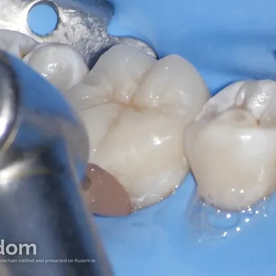 Complex Lower Molar Retreatment - Image 18