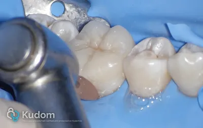 Ritrattamento Complesso Molare Inferiore - Immagine 18