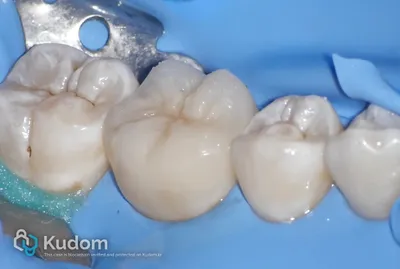 Ritrattamento Complesso Molare Inferiore - Immagine 19